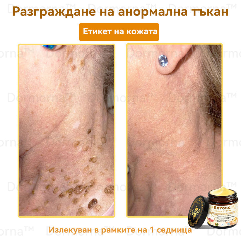 Официален представител на клиниката Майо:: 🦙𝐒𝐩𝐳𝐯™ Ботокс Пчелна отрова Крем за третиране на кожата, Хидратиране, възстановяване на кожата, изравняване на тена, лечение на акне и тъмни петна, премахване на брадавици и бенки, облекчаване на псориазис