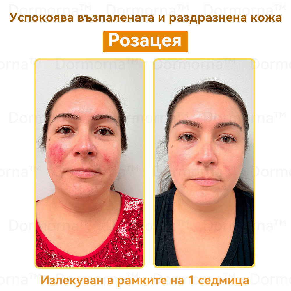 Официален представител на клиниката Майо:: 🦙𝐒𝐩𝐳𝐯™ Ботокс Пчелна отрова Крем за третиране на кожата, Хидратиране, възстановяване на кожата, изравняване на тена, лечение на акне и тъмни петна, премахване на брадавици и бенки, облекчаване на псориазис