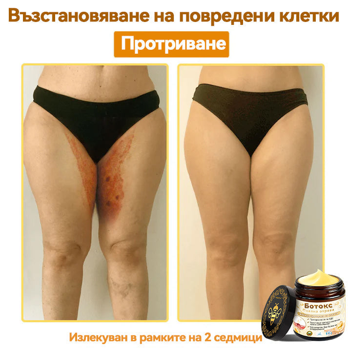 Официален представител на клиниката Майо:: 🦙𝐒𝐩𝐳𝐯™ Ботокс Пчелна отрова Крем за третиране на кожата, Хидратиране, възстановяване на кожата, изравняване на тена, лечение на акне и тъмни петна, премахване на брадавици и бенки, облекчаване на псориазис