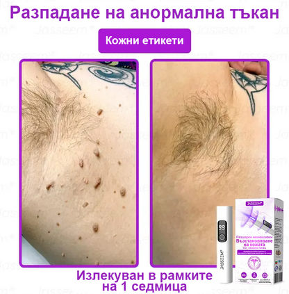 𝐉𝐚𝐬𝐬𝐞𝐞𝐦® Усъвършенствана неинвазивна CO₂ лазерна писалка за възстановяване на кожата 💕 (Нежно премахва брадавици, родилни белези, старчески петна и кожни образувания - без болка, без притеснения!)