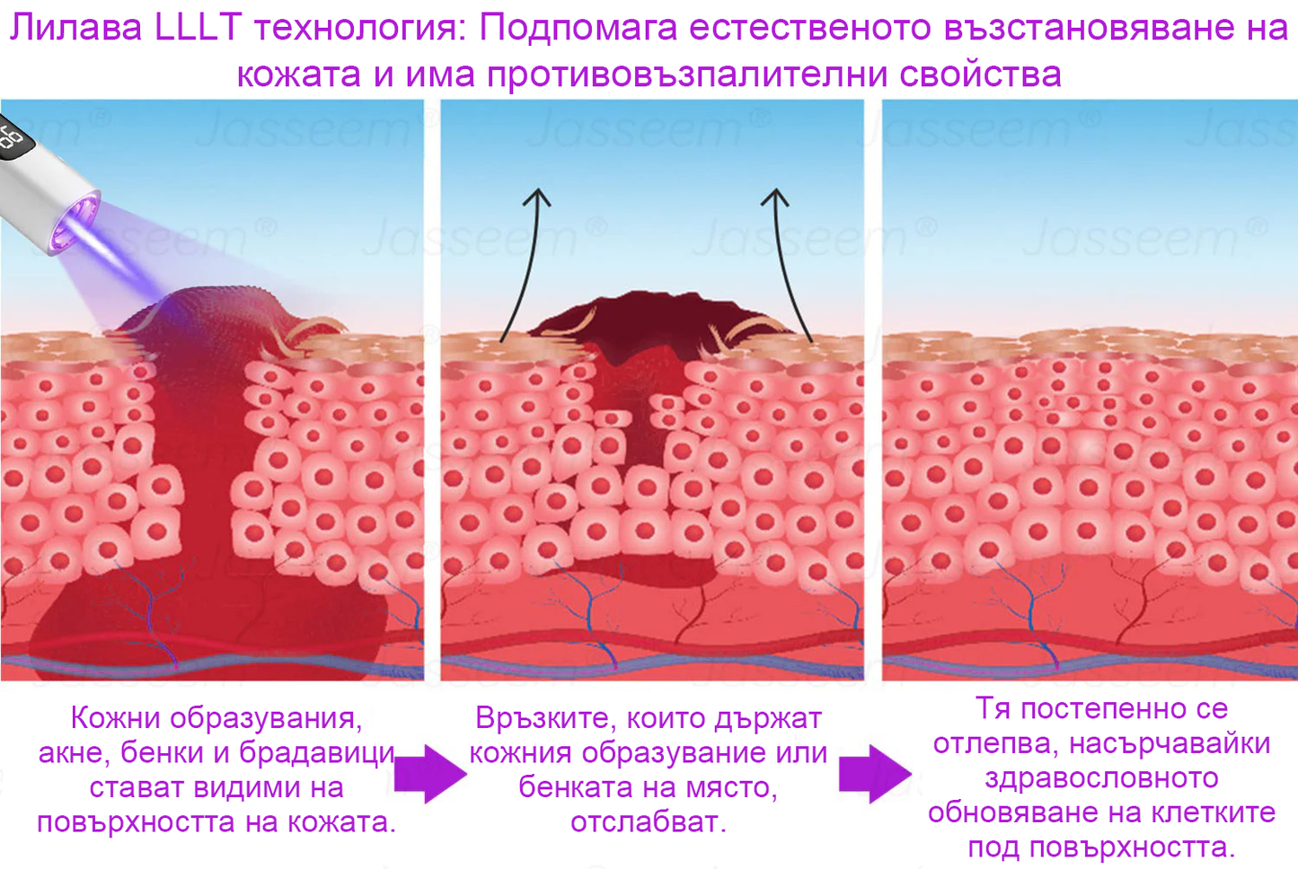 𝐉𝐚𝐬𝐬𝐞𝐞𝐦® Усъвършенствана неинвазивна CO₂ лазерна писалка за възстановяване на кожата 💕 (Нежно премахва брадавици, родилни белези, старчески петна и кожни образувания - без болка, без притеснения!)