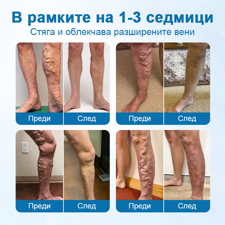 Timilk® VeinGuard – Билков спрей за разширени вени с доказана ефективност след 7 дни!🌿