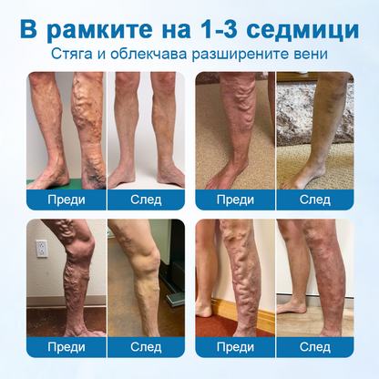 Timilk® VeinGuard – Билков спрей за разширени вени с доказана ефективност след 7 дни!🌿