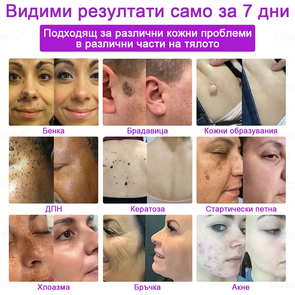 𝐉𝐚𝐬𝐬𝐞𝐞𝐦® Усъвършенствана неинвазивна CO₂ лазерна писалка за възстановяване на кожата 💕 (Нежно премахва брадавици, родилни белези, старчески петна и кожни образувания - без болка, без притеснения!)