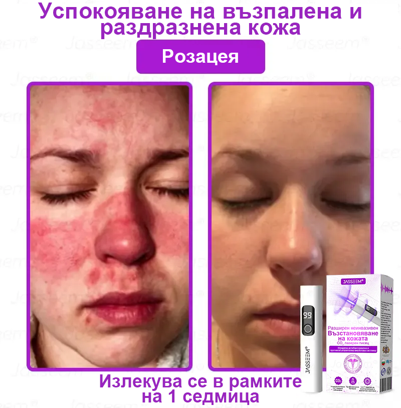 𝐉𝐚𝐬𝐬𝐞𝐞𝐦® Усъвършенствана неинвазивна CO₂ лазерна писалка за възстановяване на кожата 💕 (Нежно премахва брадавици, родилни белези, старчески петна и кожни образувания - без болка, без притеснения!)