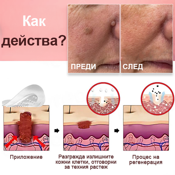 KUBOZN® Нано-микроиглени пластири за премахване на кожни етикети