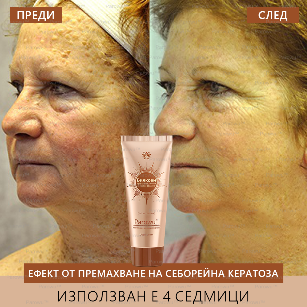 Parowu™ Изсветляваща и премахваща петна маска - 💗Натурални съставки за дълготрайно премахване на петна, хиперпигментации и слънчеви петна